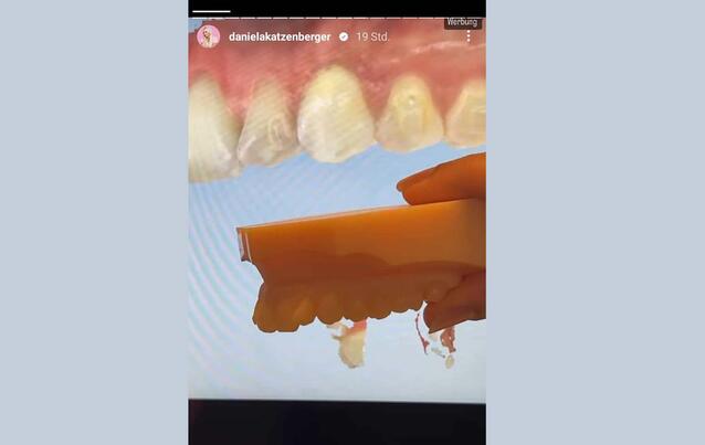 Daniela Katzenberger: Ihre Zähne brauchen Hilfe